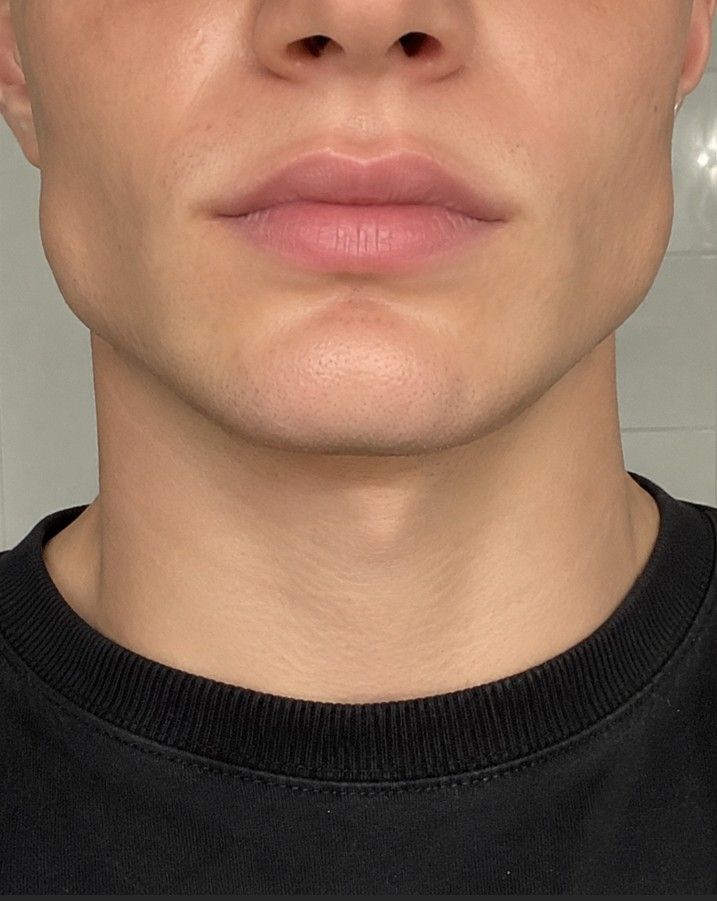 Before masseter botox treatment showing square jawline — Signature Aesthetics Nottingham