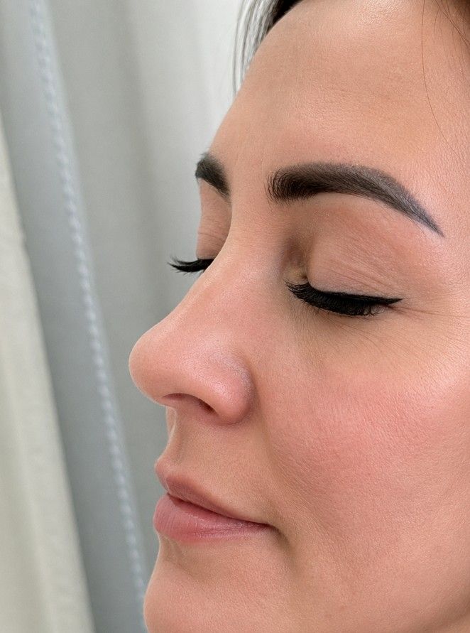 Before non-surgical rhinoplasty showing dorsal nose bump — Signature Aesthetics Nottingham