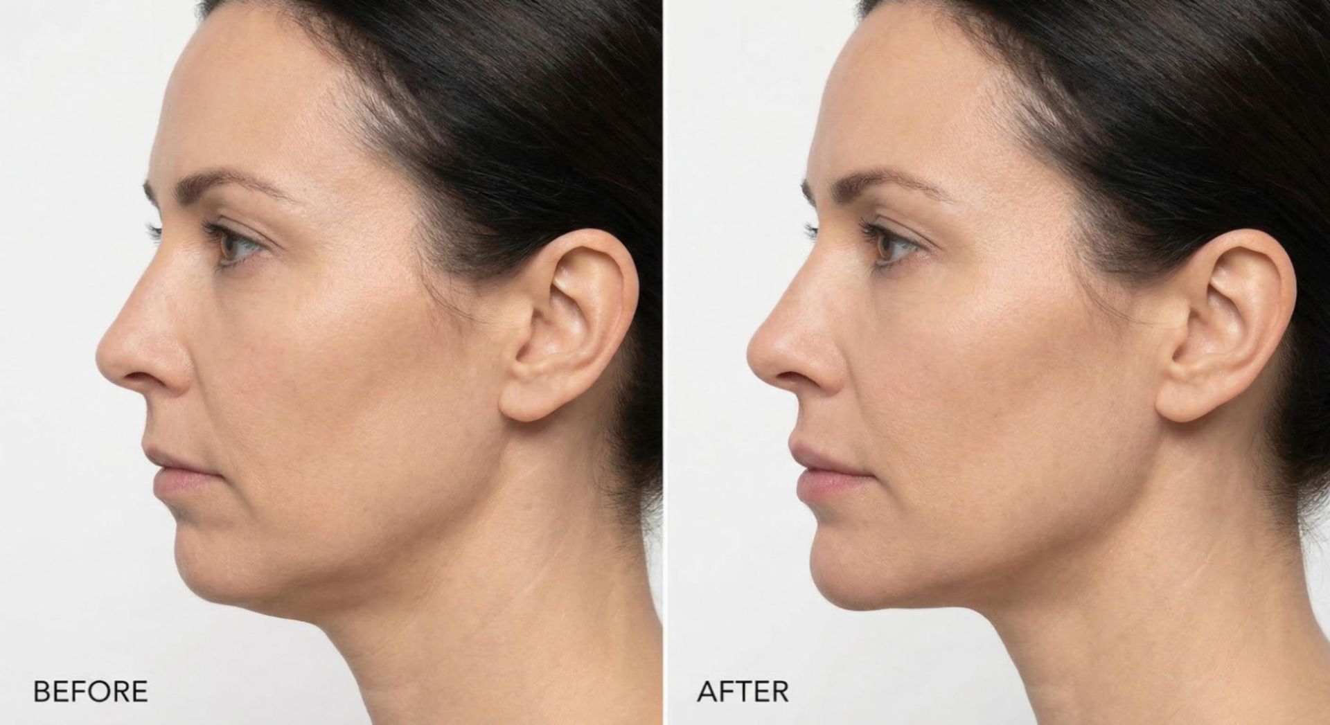 Side profile before and after comparison showing chin projection and facial balance with chin filler