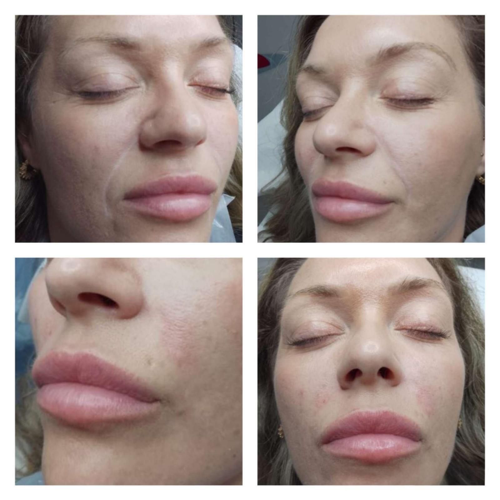 Selection of before and after client images showing natural nasolabial fold softening using dermal fillers