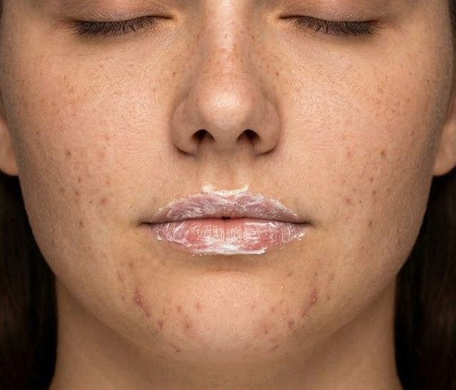 before lip filler treatment at Signature Aesthetics in Nottingham
