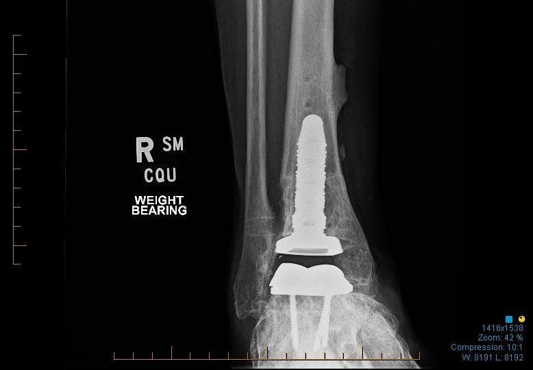 Dr Yeo Brisbane Foot & Ankle Surgeon