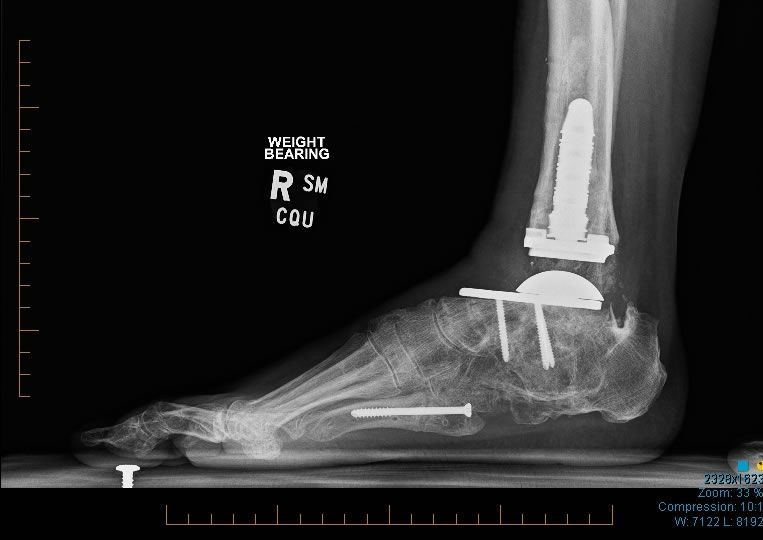 Dr Yeo Brisbane Foot & Ankle Surgeon