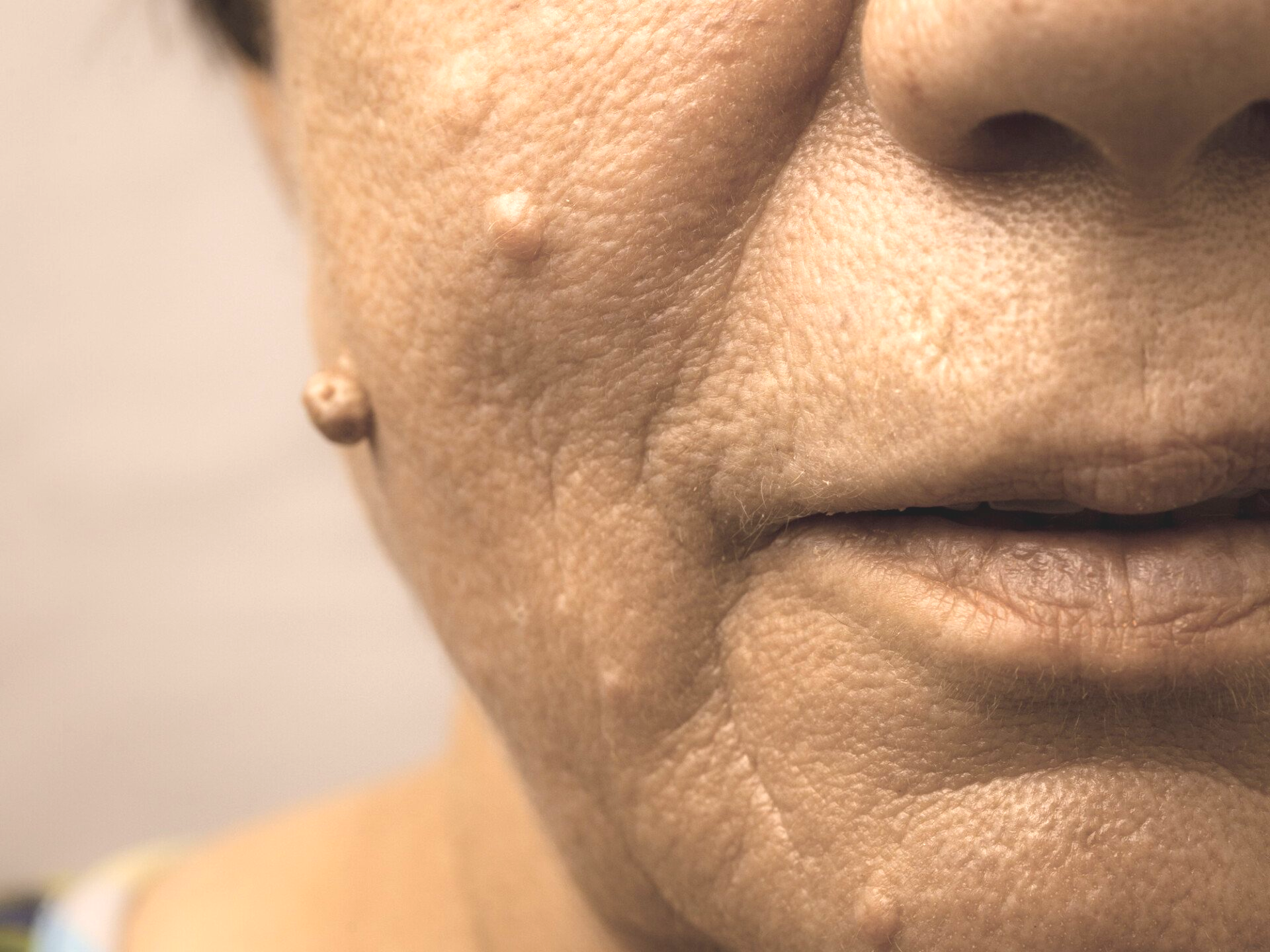 woman with skin tags