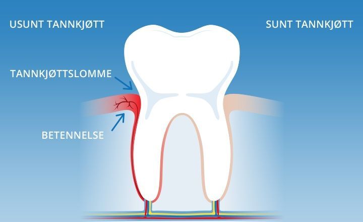 Gingivitt - Lillsestrøm tannlege