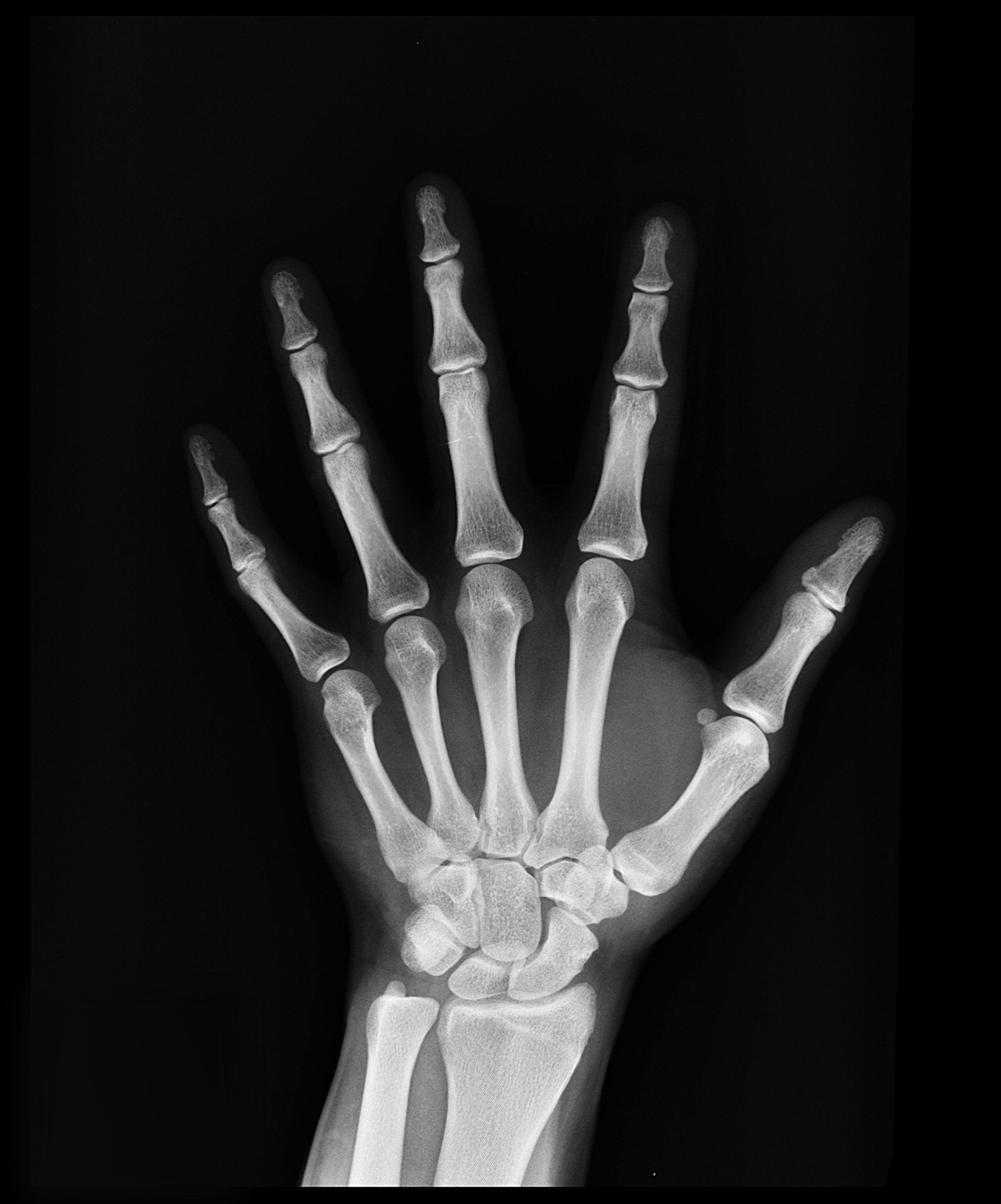 x ray results of a hand with carpal tunnel syndrome