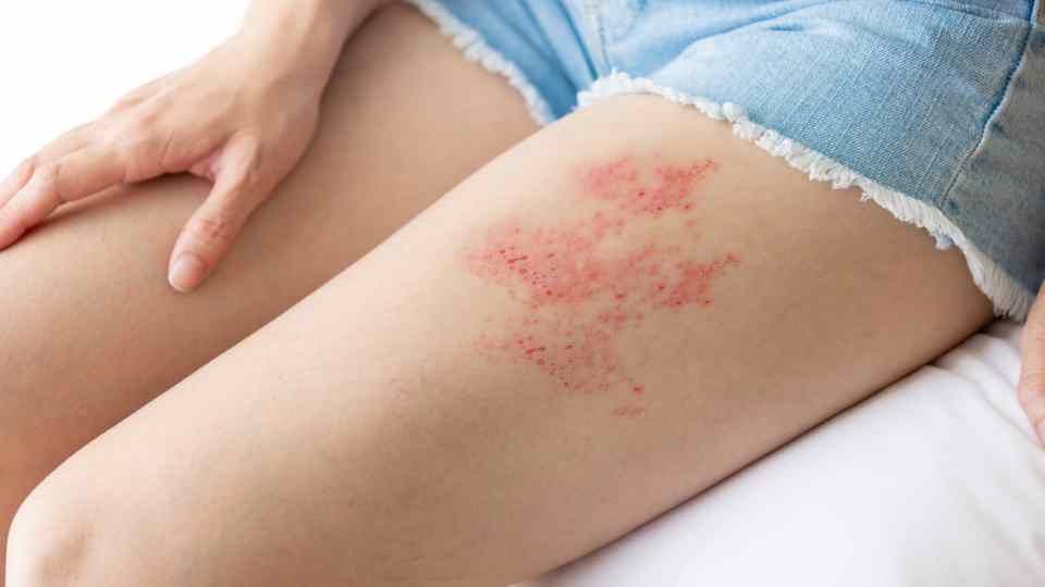 shingles treatment widnes