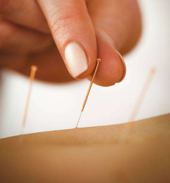 Hand inserting acupuncture needle into skin, other needles in the background.