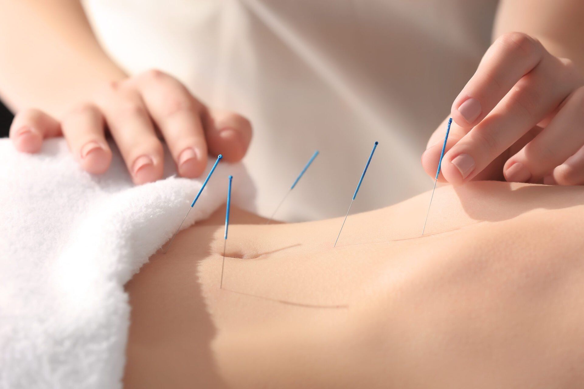 Hands placing acupuncture needles on a person's abdomen, white towel, light skin.
