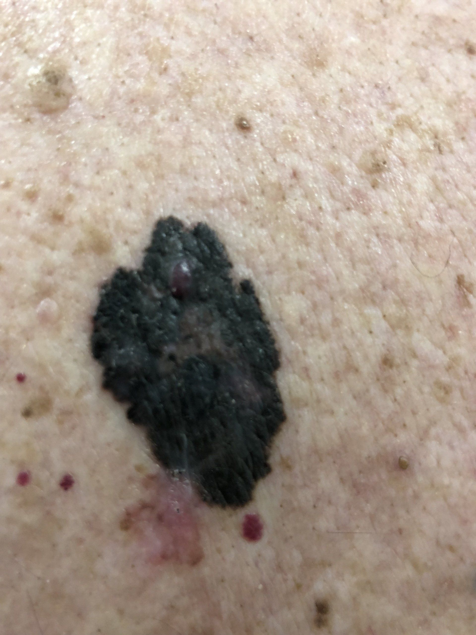 Melanoma