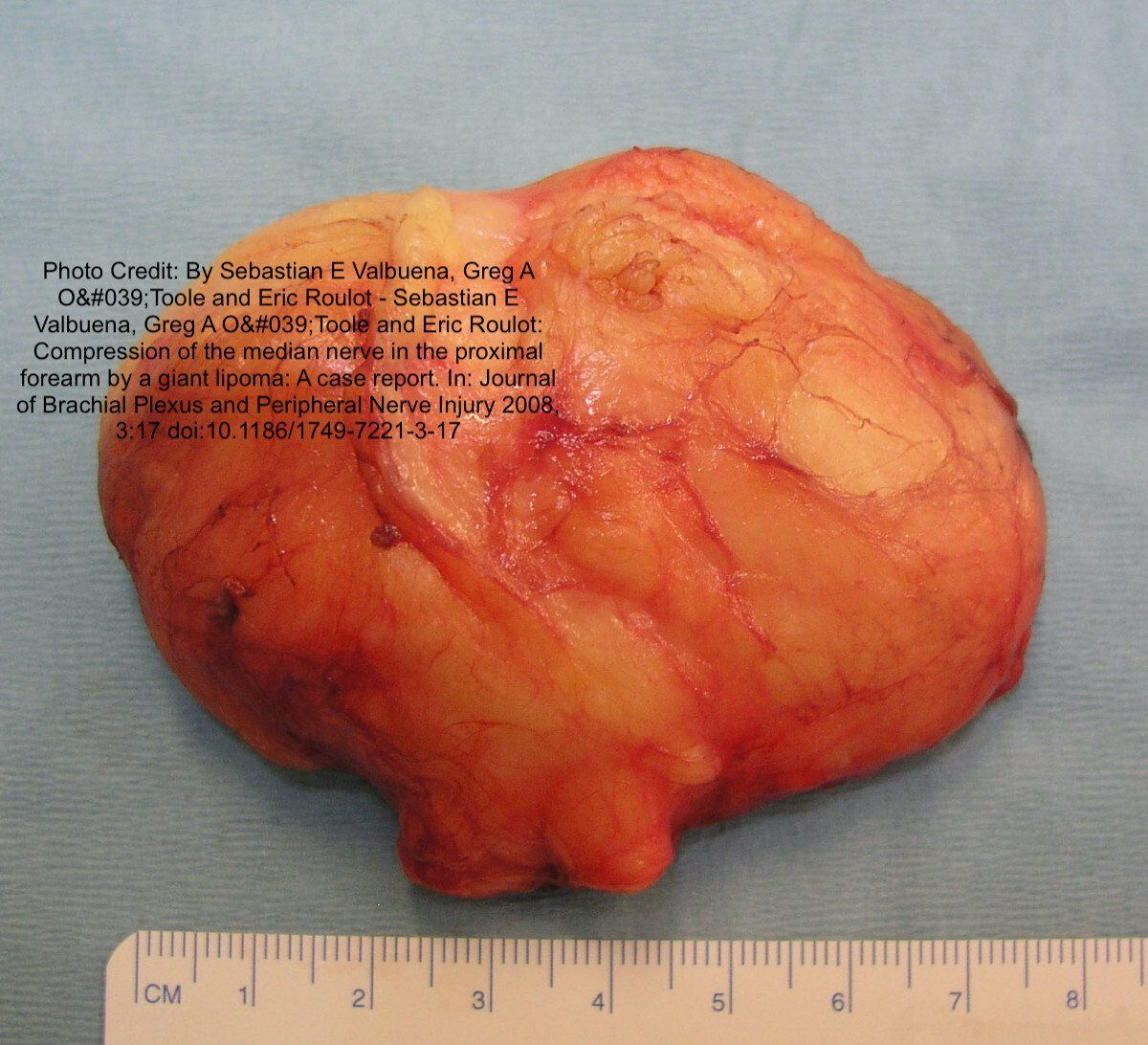 What Is a Lipoma? Symptoms, Diagnosis, Treatment, and Cancer Risk