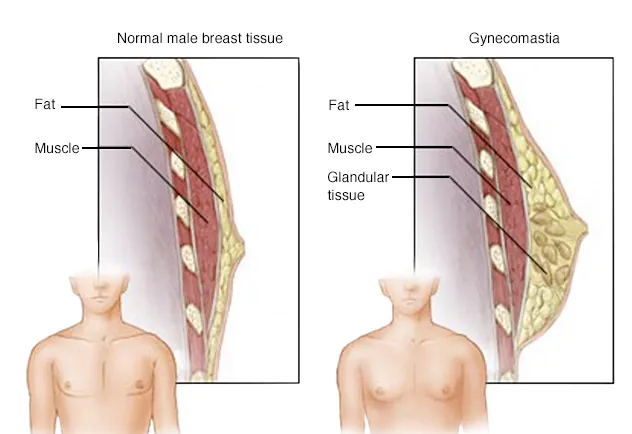 Gynaecomastia