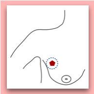 Lumpectomy for breast cancer surgery