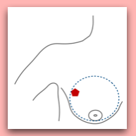 Simple or total mastectomy for breast cancer surgery