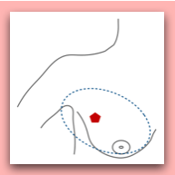 Modified Radical Mastectomy
