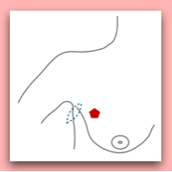 Sentinel Node biopsy or Axillary Lymph Node dissection