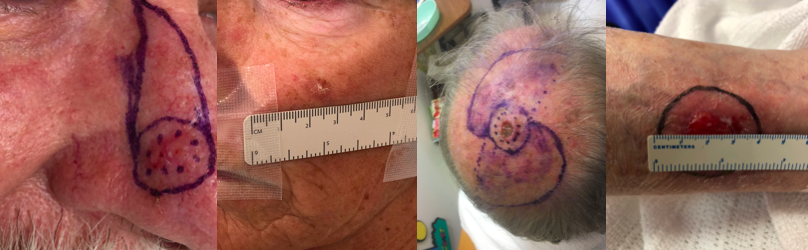 Melanoma
