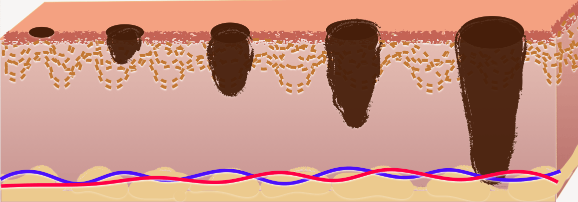 What are stages of melanoma?