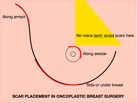 Oncoplastic Breast Surgery