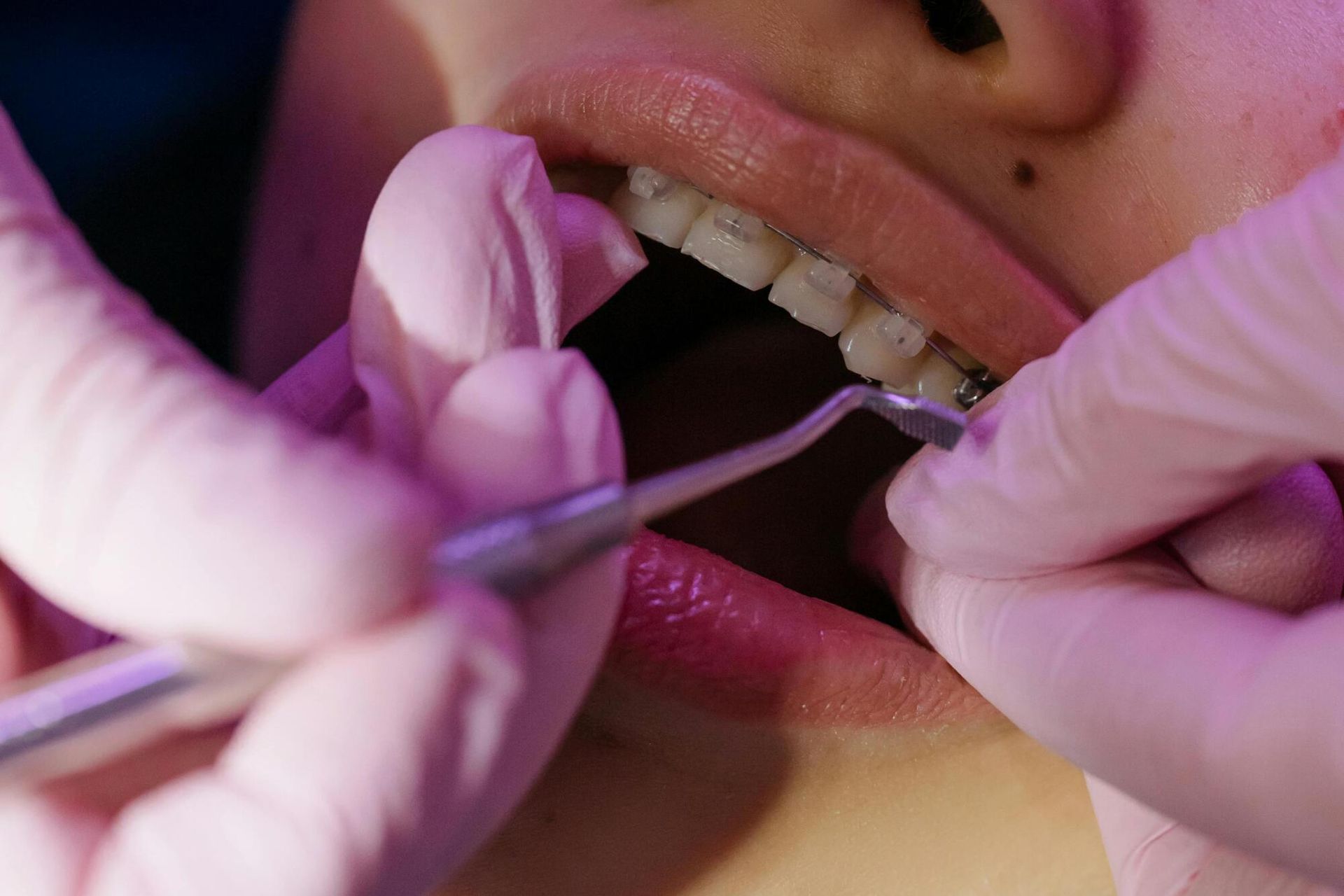 Dentist's hands in pink gloves examining teeth with braces using a metal instrument, close up.