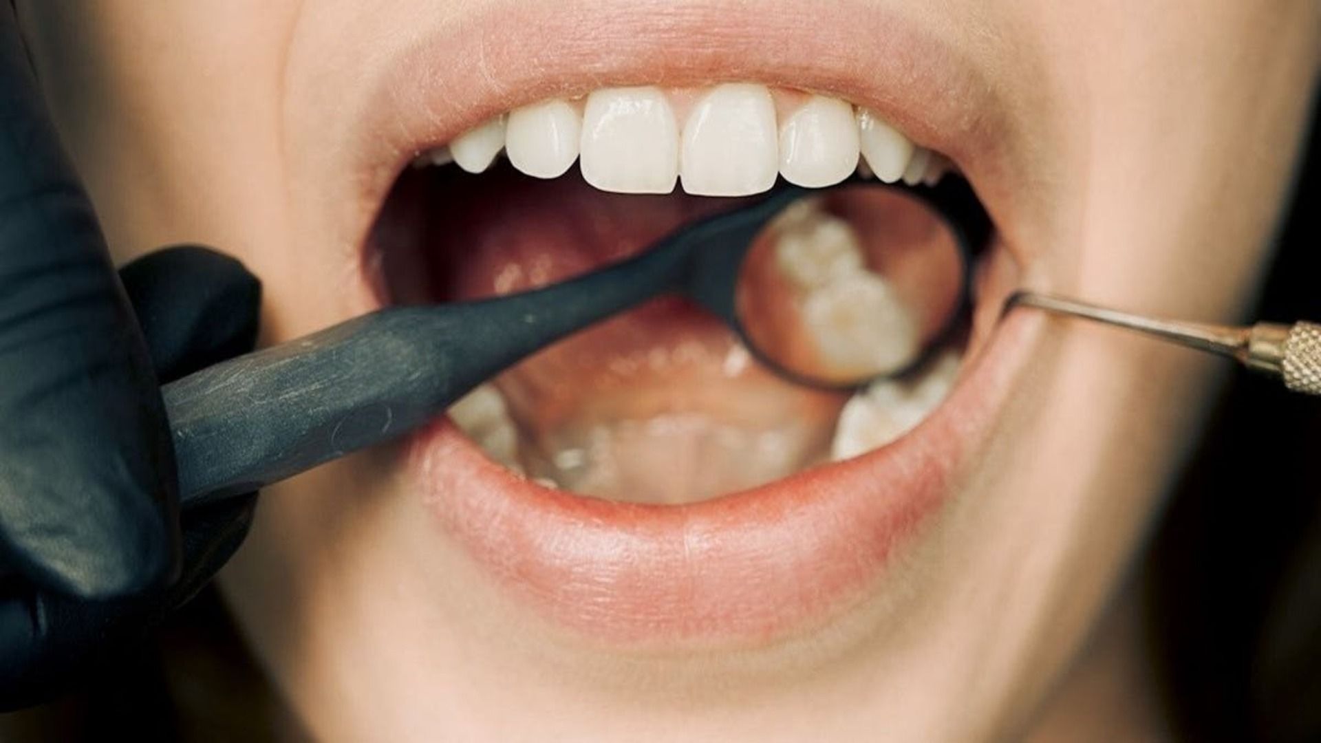 Dentista examinando una boca con espejo y herramienta; dientes blancos, guante negro, boca abierta.