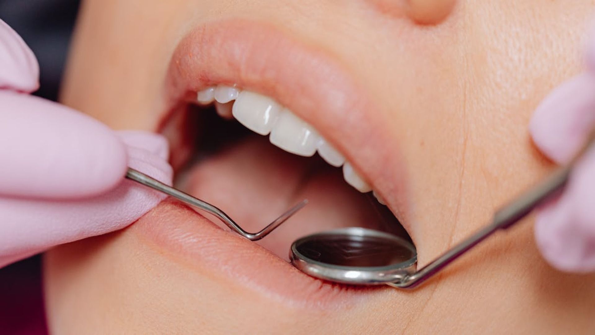 Boca abierta durante el examen dental, herramientas en uso, mostrando dientes y encías.