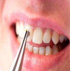 DRA. ELIZABETH GONZÁLEZ ENDODONCIA INTEGRAL - ultrasonido, pulverizador y cepillo pulidor