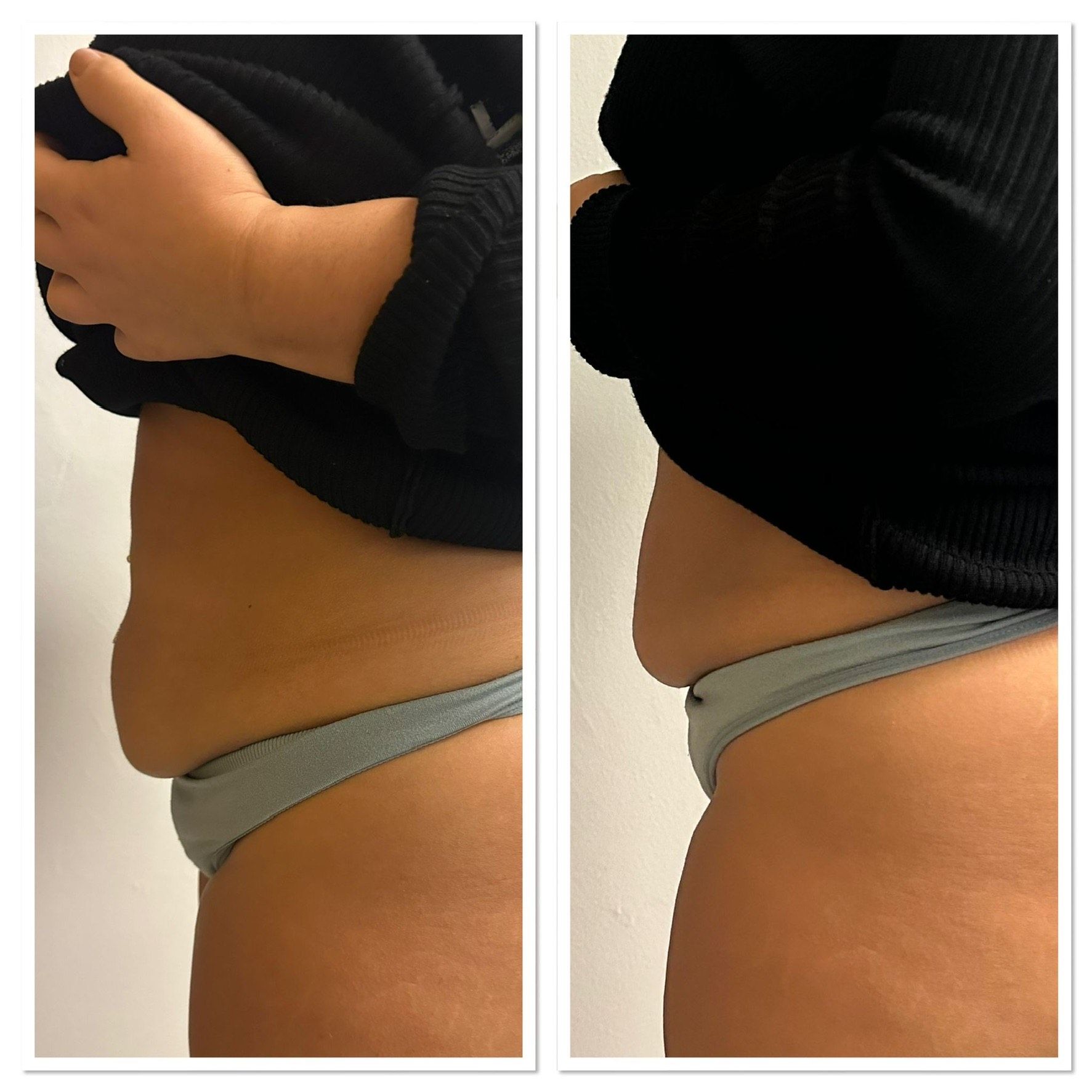 Fotos des Oberkörpers nebeneinander zeigen Taille und Bauch einer Person in grauer Unterwäsche und einem hochgezogenen schwarzen Oberteil.