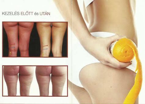 Vorher-nachher-Bilder der Cellulite-Behandlung: Die Beine weisen eine deutliche Reduzierung der Dellen auf, während eine Hand Orangenöl aufträgt.