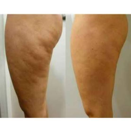 Nahaufnahme im direkten Vergleich vor und nach der Behandlung, die eine Reduzierung der Cellulite und eine glattere Haut zeigt.