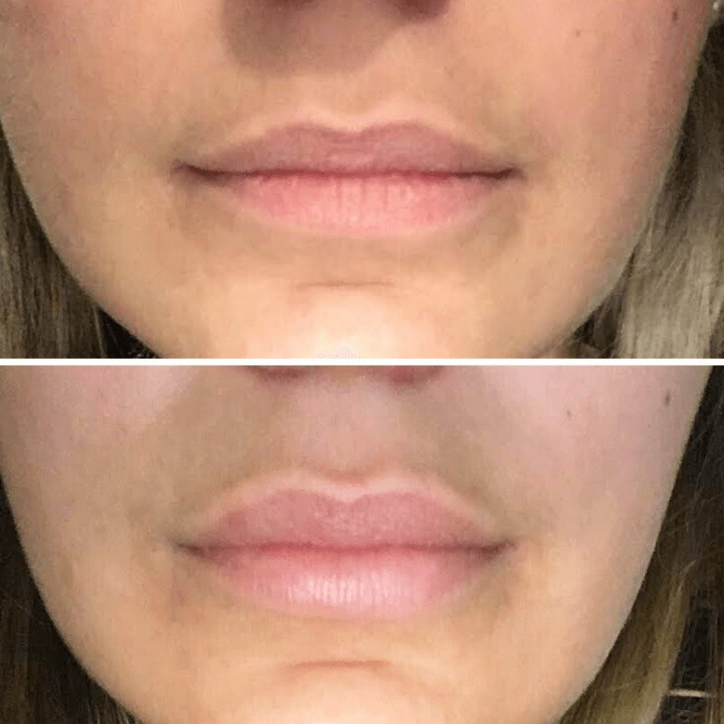 Nahaufnahme der Lippen auf zwei nebeneinanderliegenden Fotos, die ein leichtes Lächeln und einen natürlichen Hautton zeigen.