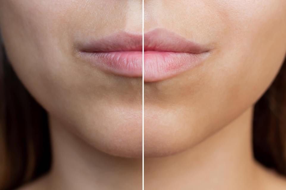 Geteilte Nahaufnahme von Lippen und Kinn, die den Unterschied im Hautton vor und nach der Behandlung durch eine vertikale Teilung zeigt.