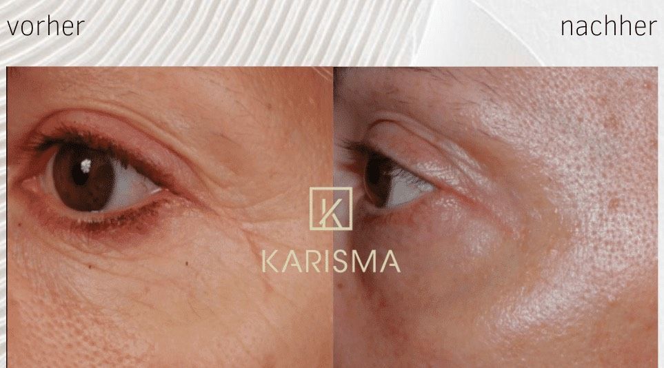 Vorher-Nachher-Nahaufnahme der Augenpartie, die rechts glattere Haut zeigt, mit dem Schriftzug „KARISMA“ als Überlagerung.