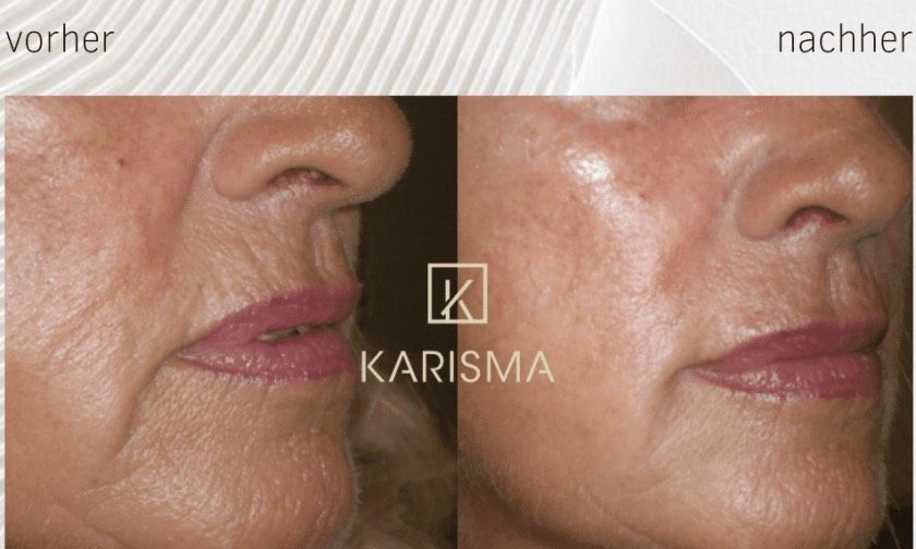 Vorher-Nachher-Nahaufnahme des unteren Gesichts einer Frau, die eine glattere Wangen- und Lippenpartie zeigt, die mit „vorher“ und „nachher“ gekennzeichnet ist.