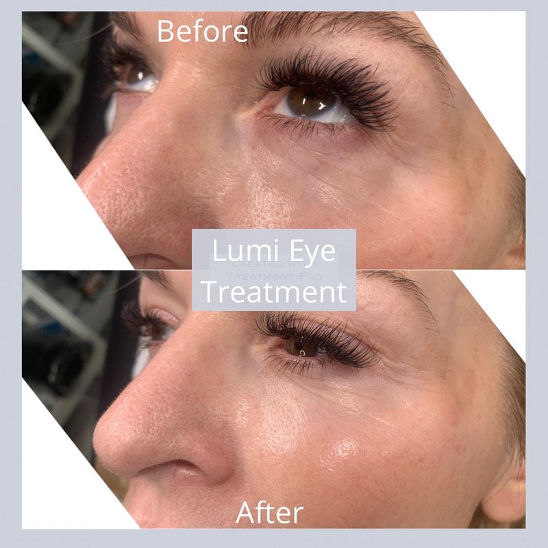Vorher-Nachher-Nahaufnahme einer Augenbehandlung, die eine glattere und strahlendere Haut unter den Augen nach der Behandlung mit Lumi Eye zeigt.