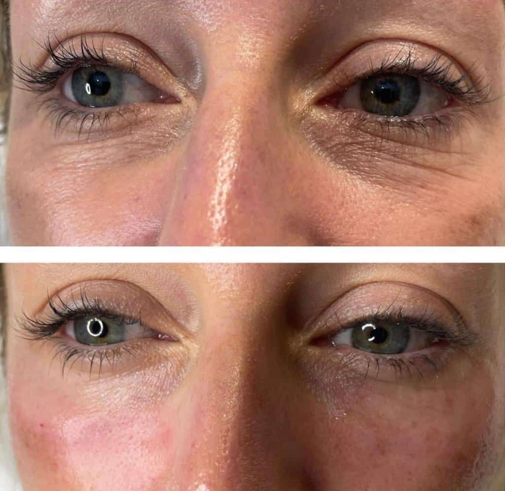 Nahaufnahme beider Augen vor und nach der Behandlung, die eine Reduzierung von Schwellungen und Falten an den Augenlidern zeigt.