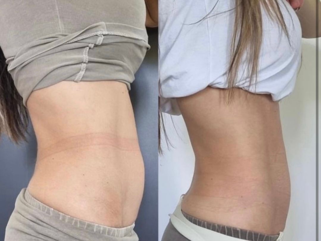 Fotos des Oberkörpers im direkten Vergleich zeigen einen flacheren Bauch nach Gewichtsverlust oder Abnehmen.