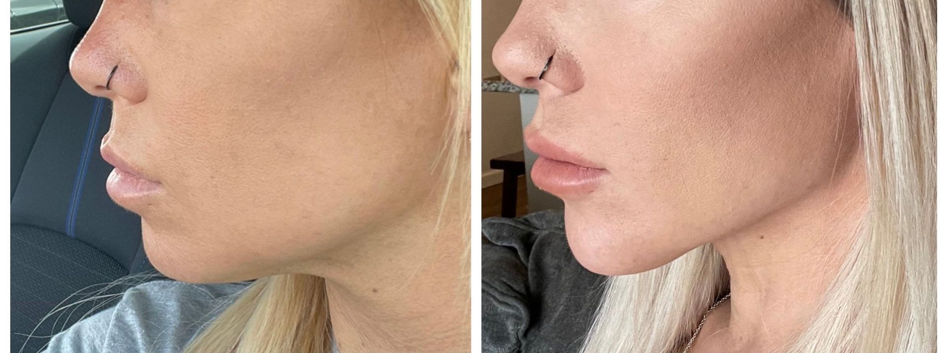 Profilfotos einer Frau im Vergleich: Kieferpartie und Hals vor und nach der Behandlung.