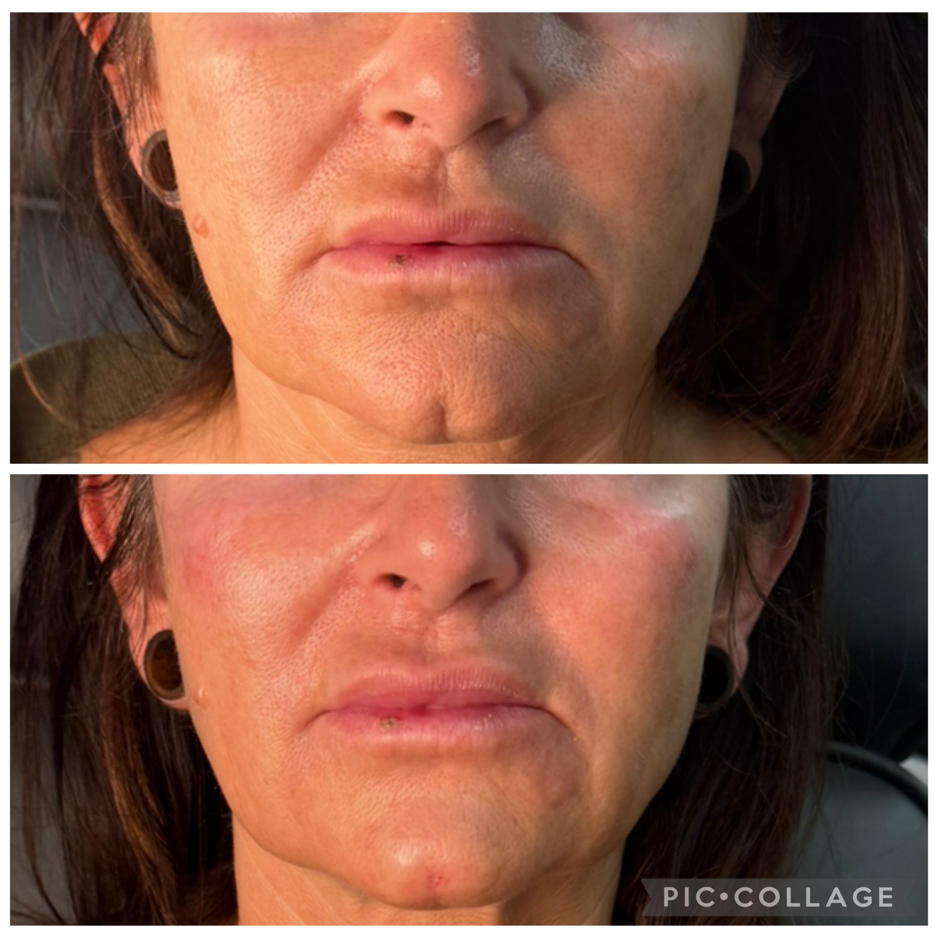Nahaufnahme vor und nach der Operation: Das untere Gesicht einer Frau zeigt glattere Lippen und Wangen.