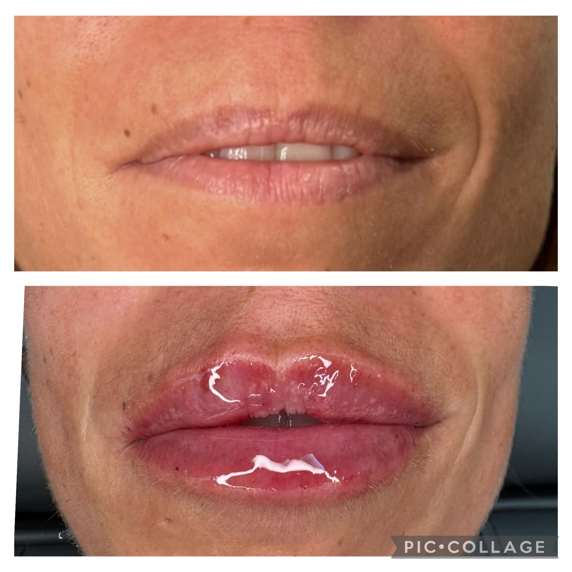 Zwei Nahaufnahmen von Lippen: oben natürlich, unten geschwollen, glänzend und gerötet.