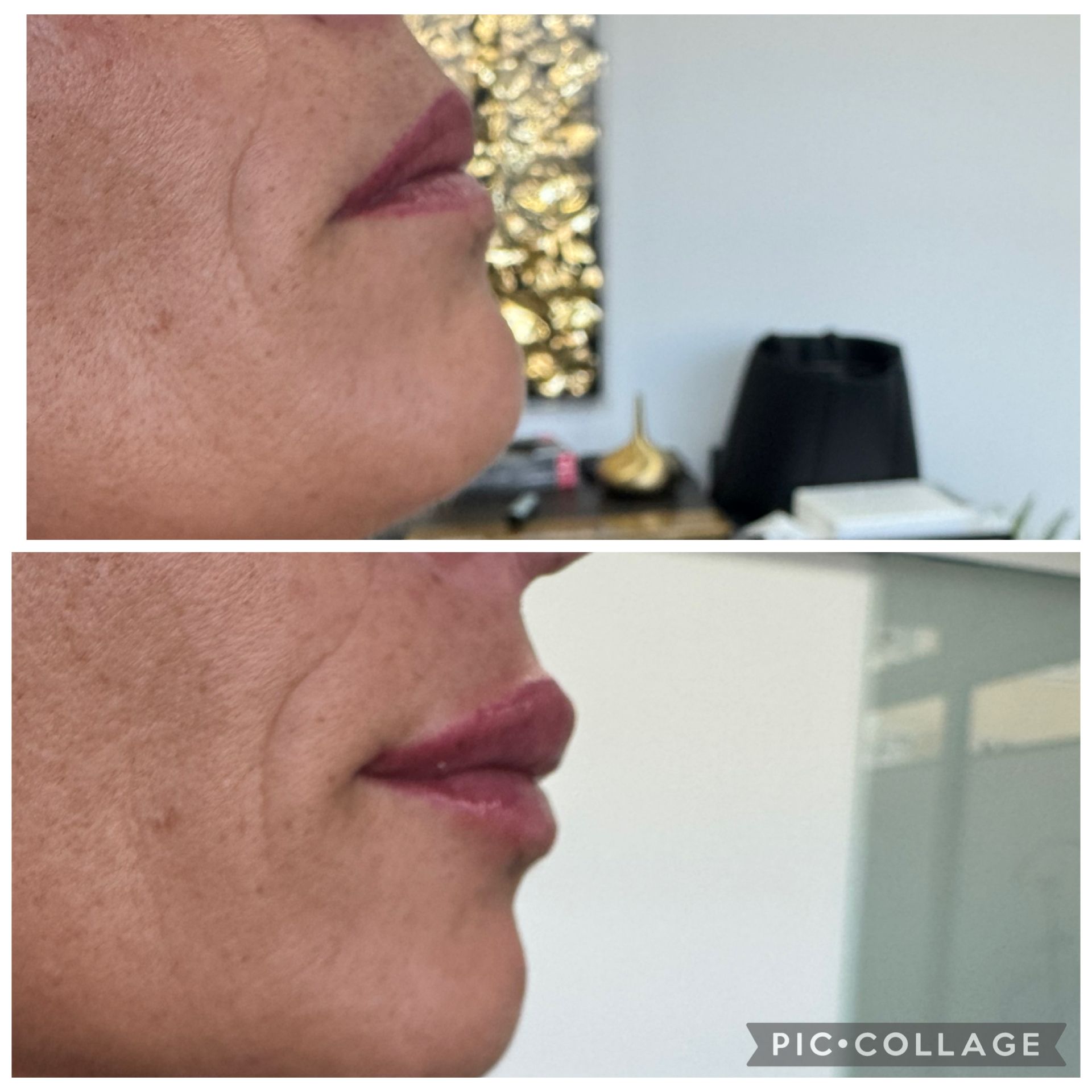 Nahaufnahmen des unteren Gesichtsbereichs und der Lippen einer Person im direkten Vergleich, vor und nach einer Lippenaufpolsterung.