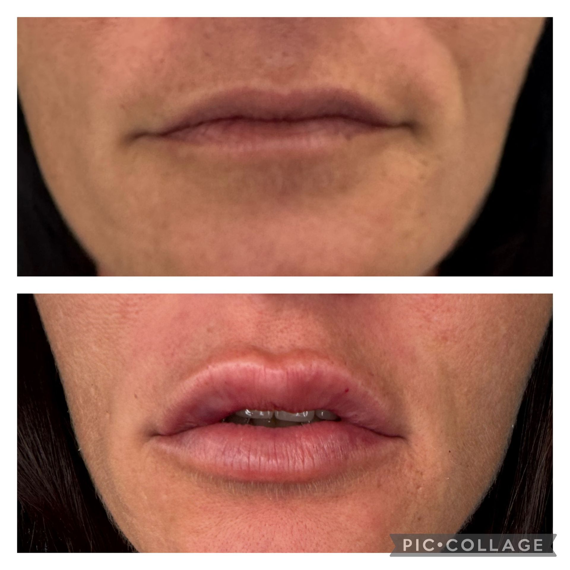 Nahaufnahme der Lippen, mit Ansichten von oben und unten, die geschlossene und leicht geöffnete Lippen mit Zahnspange zeigen.