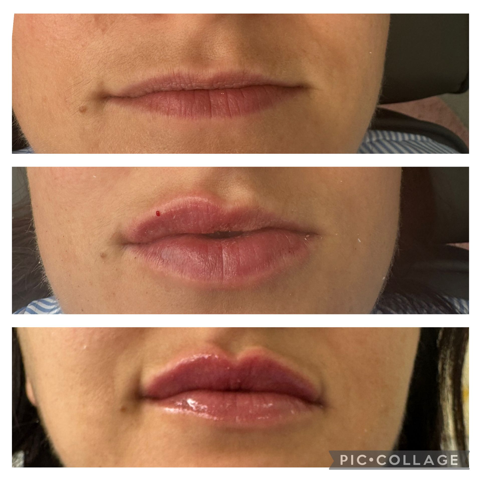 Drei übereinander angeordnete Nahaufnahmen der Lippen zeigen zunehmend glänzendere Lippen mit leichter Schwellung.