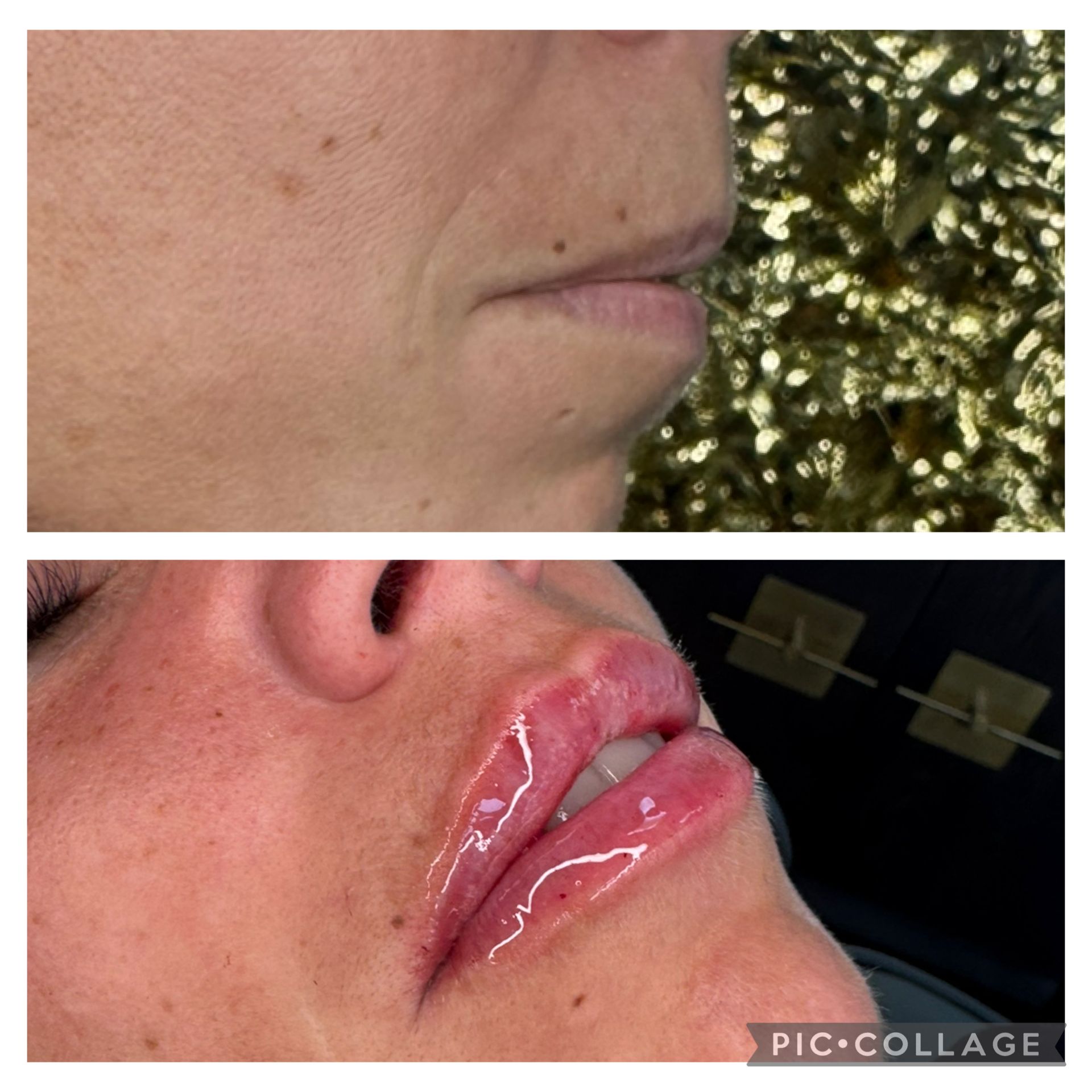 Nahaufnahmen im direkten Vergleich einer Kinn- und Lippenvergrößerung mit glänzendem Filler-Ergebnis