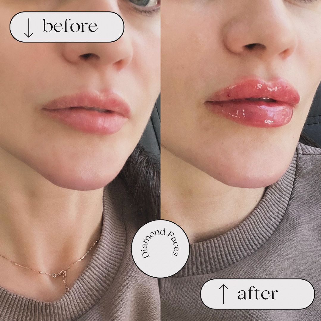 Nahaufnahme vorher und nachher: Lippen mit natürlichem Rosa links, glänzende, vollere Lippen rechts.