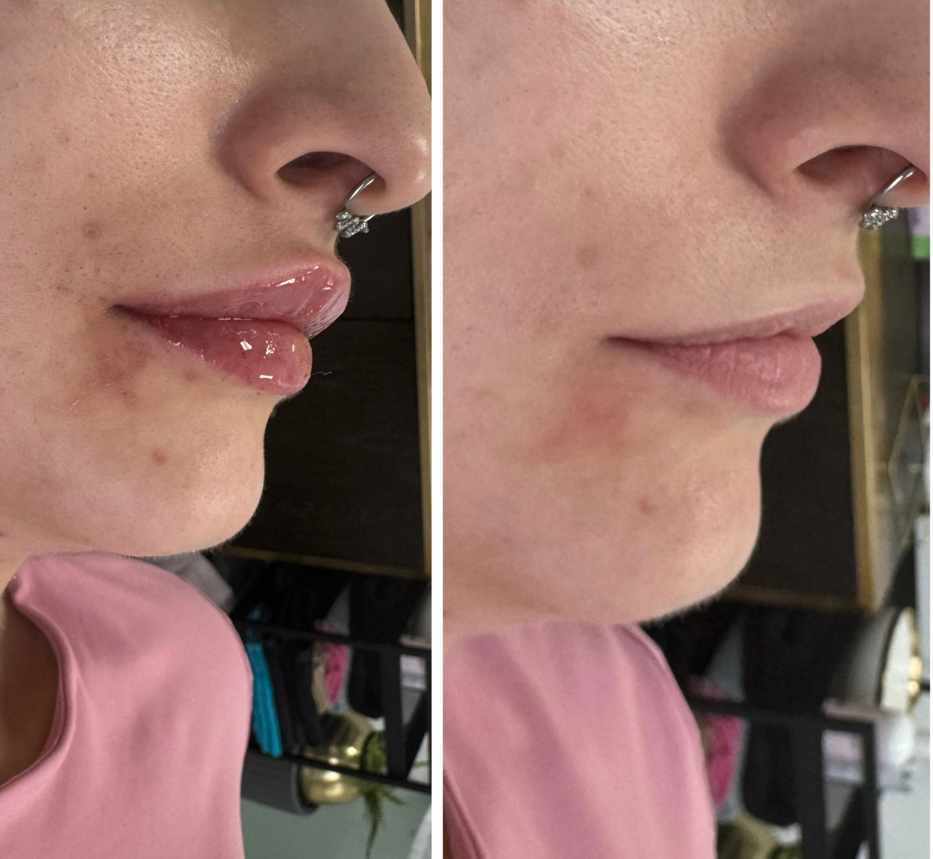 Nahaufnahmen von Lippen und Nase im Profil nebeneinander, links mit glänzenden Lippen, rechts mit ungeschminkten Lippen.
