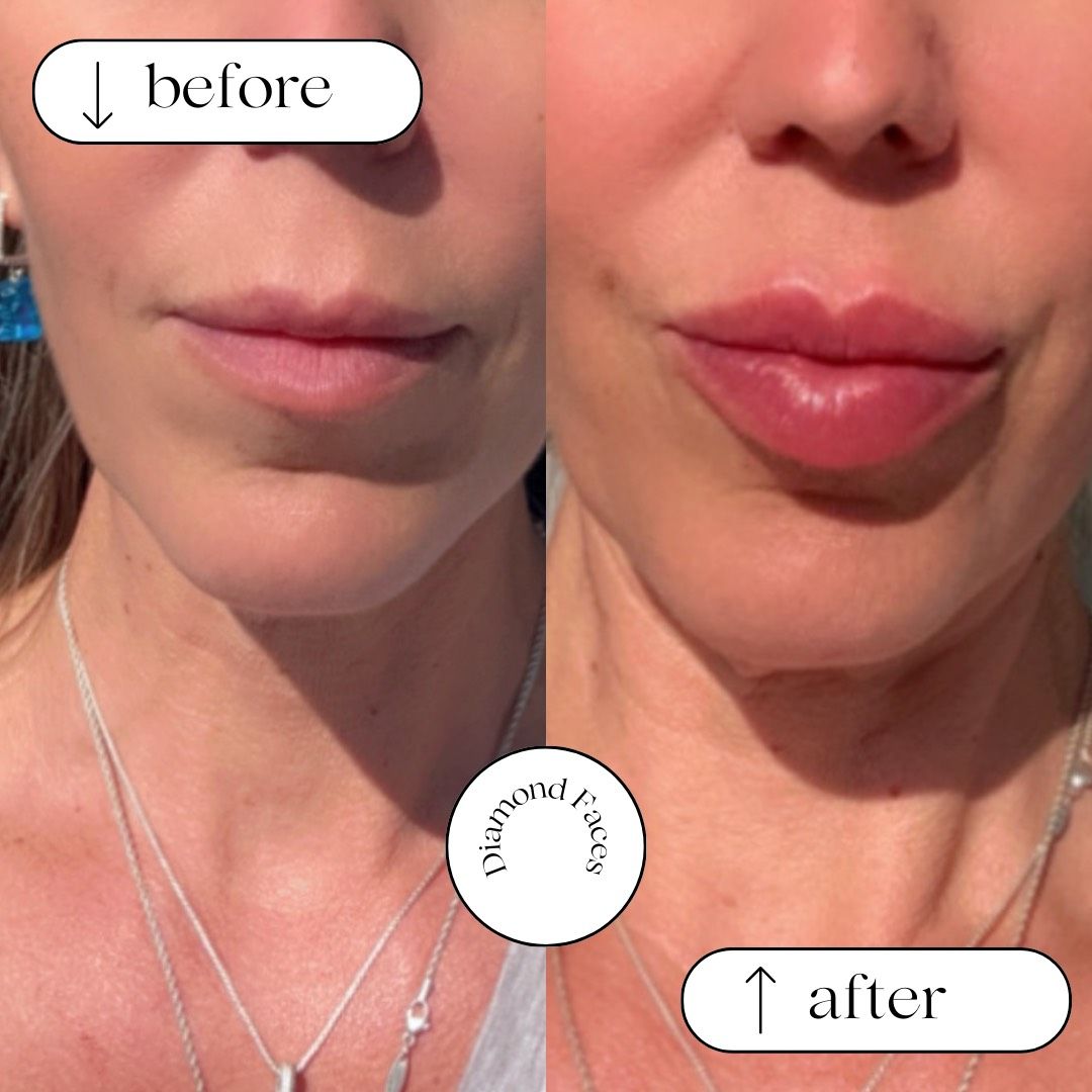 Vorher-Nachher-Nahaufnahme des unteren Gesichts einer Person, wobei im Nachher-Bild vollere Lippen zu sehen sind.
