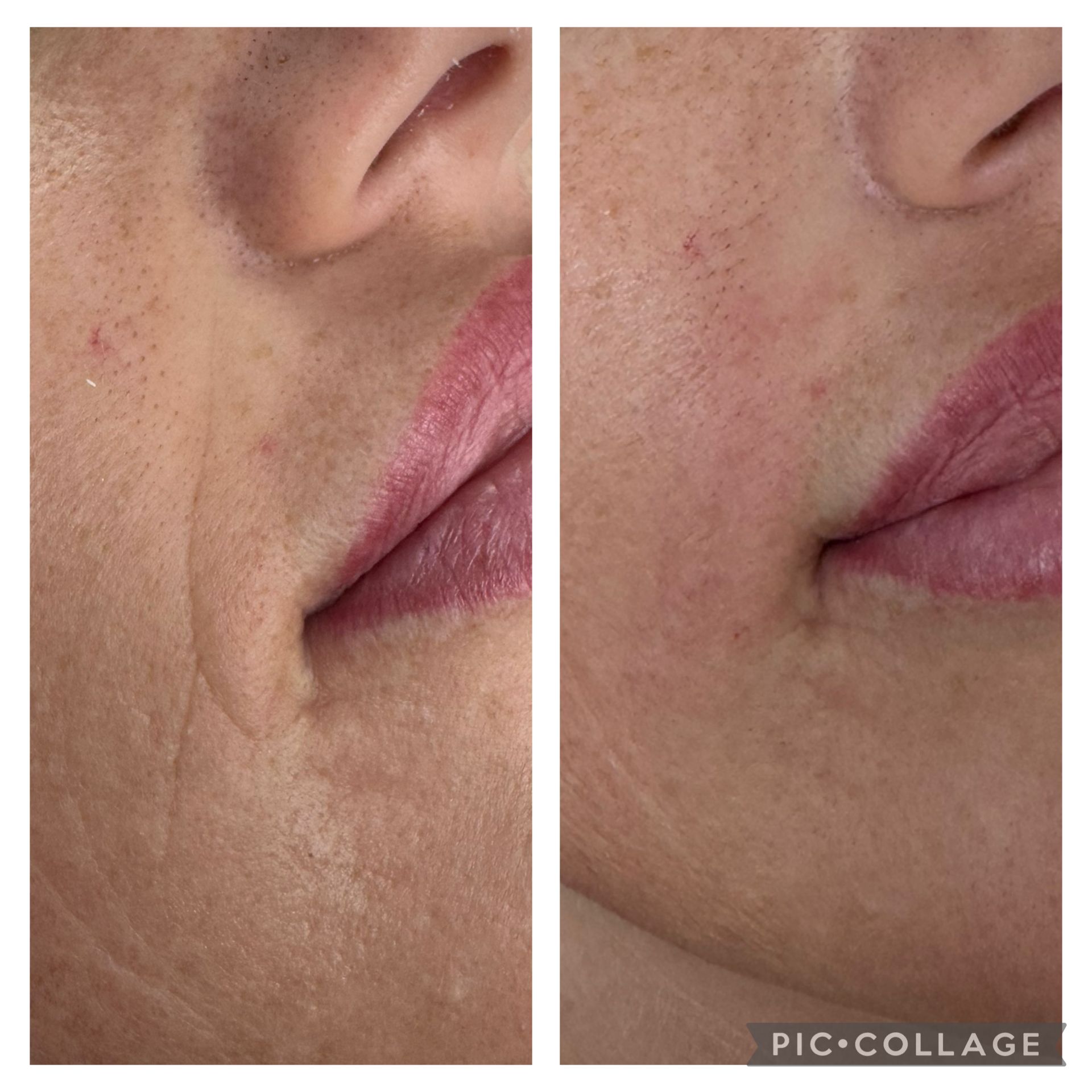 Nahaufnahme von Wange und Lippen vor und nach der Hautglättungsbehandlung im direkten Vergleich.