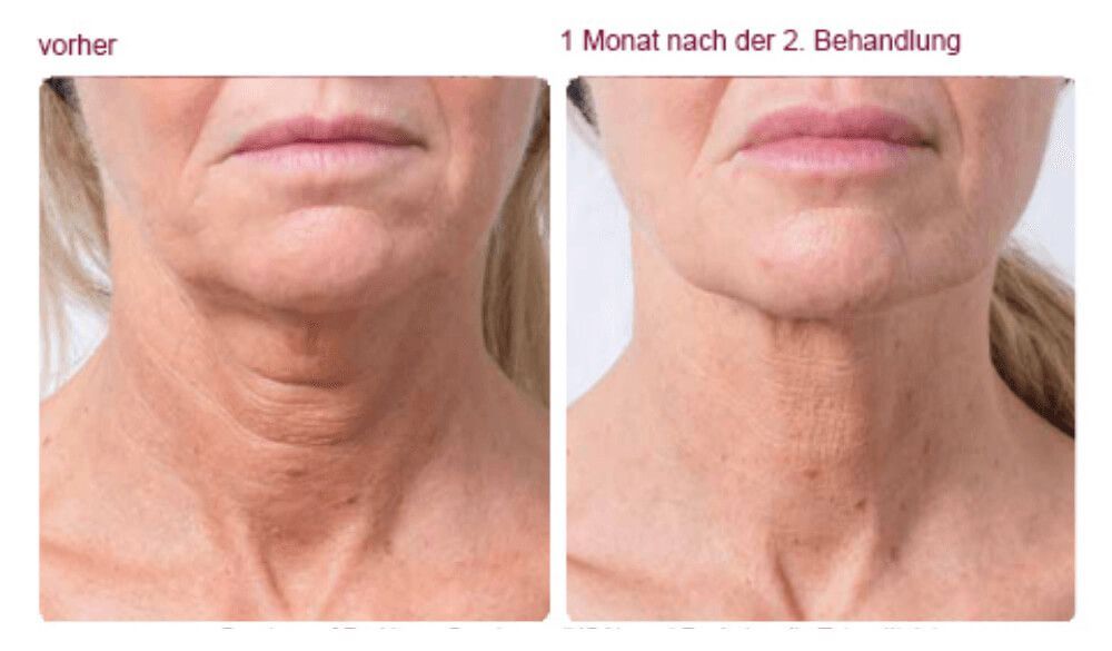 Vorher-Nachher-Foto des Halses mit glatterer Haut nach 2. Behandlung