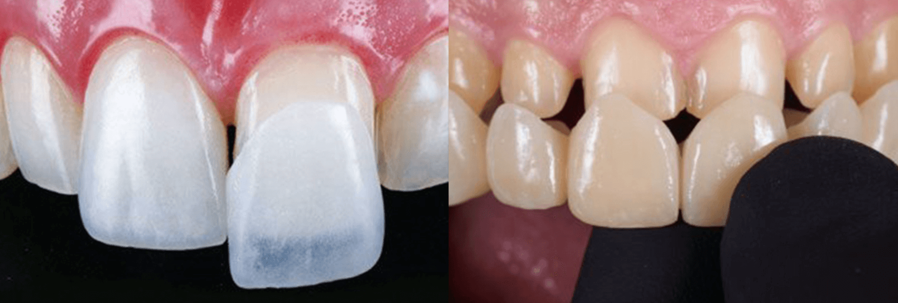 Premium Porcelain Veneers at YONSEI GOOD DAY Dental Clinic in Seoul